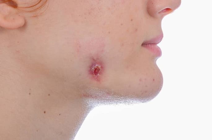 Austritt von Material