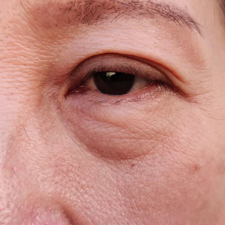 Feine Linien unter den Augen