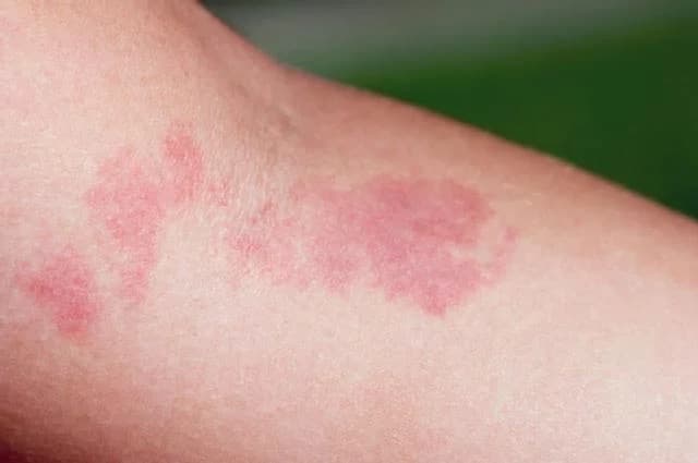 Feuermale (Naevus flammeus)