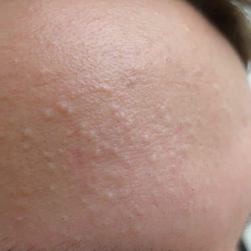 Geschlossene Mitesser