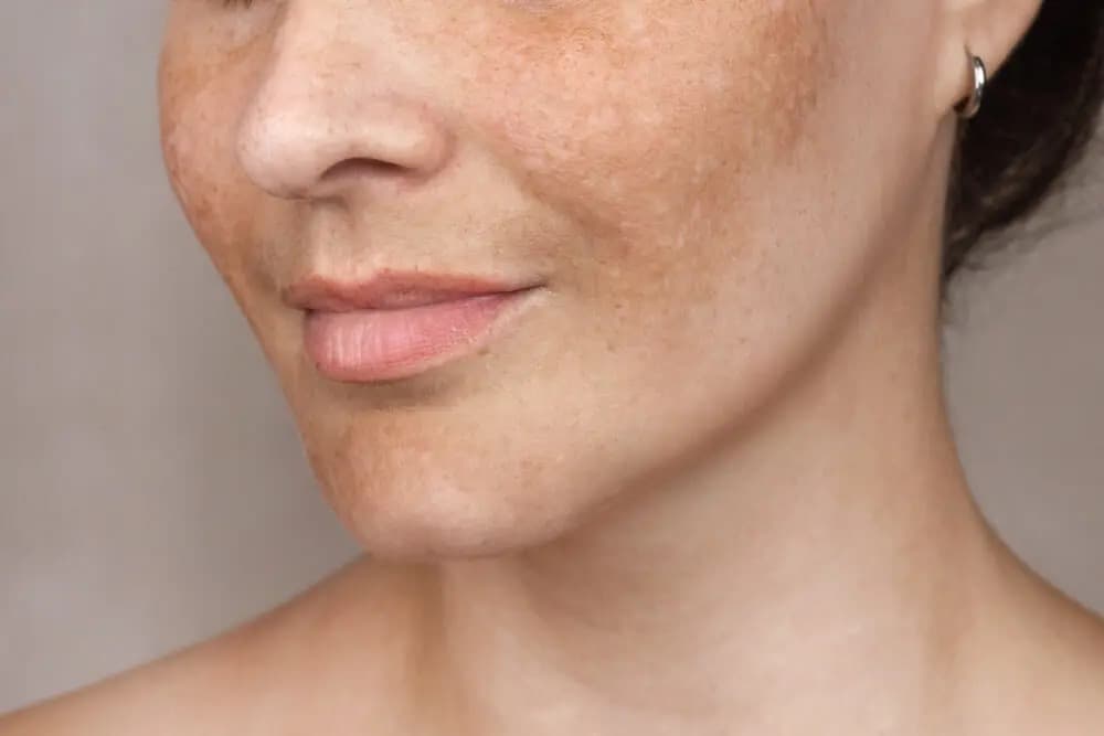 Melasma