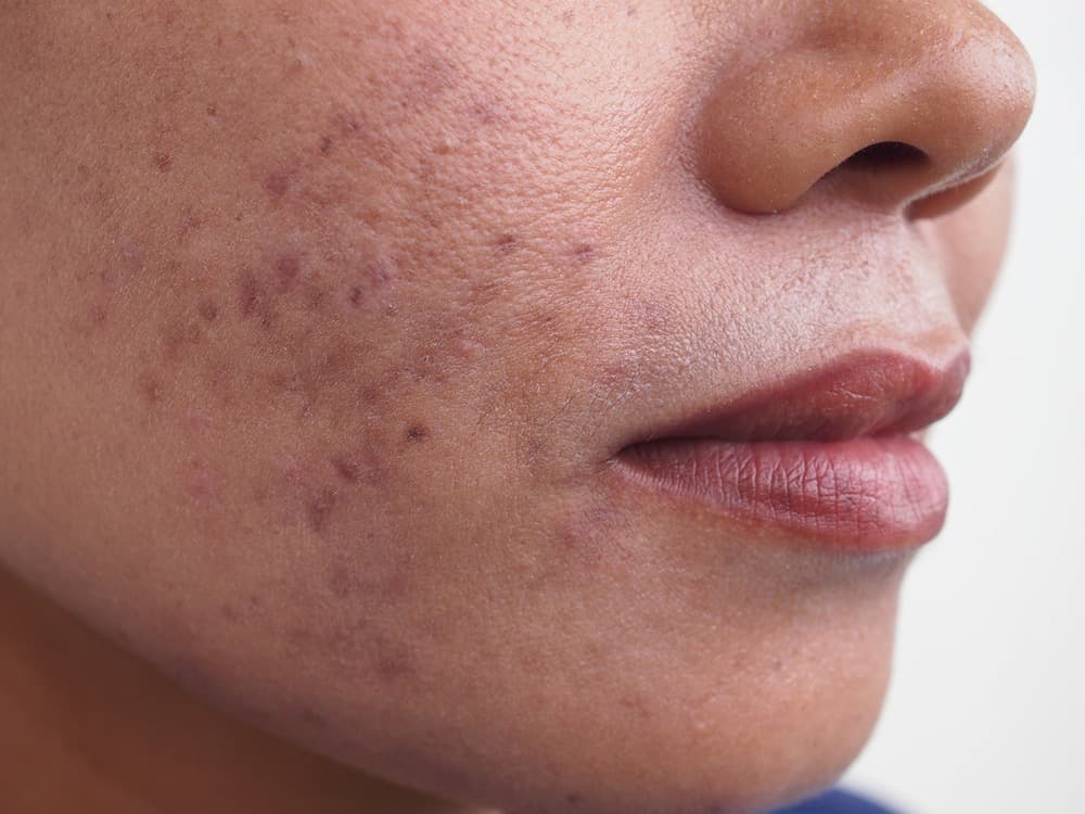 Postinflammatorische Flecken