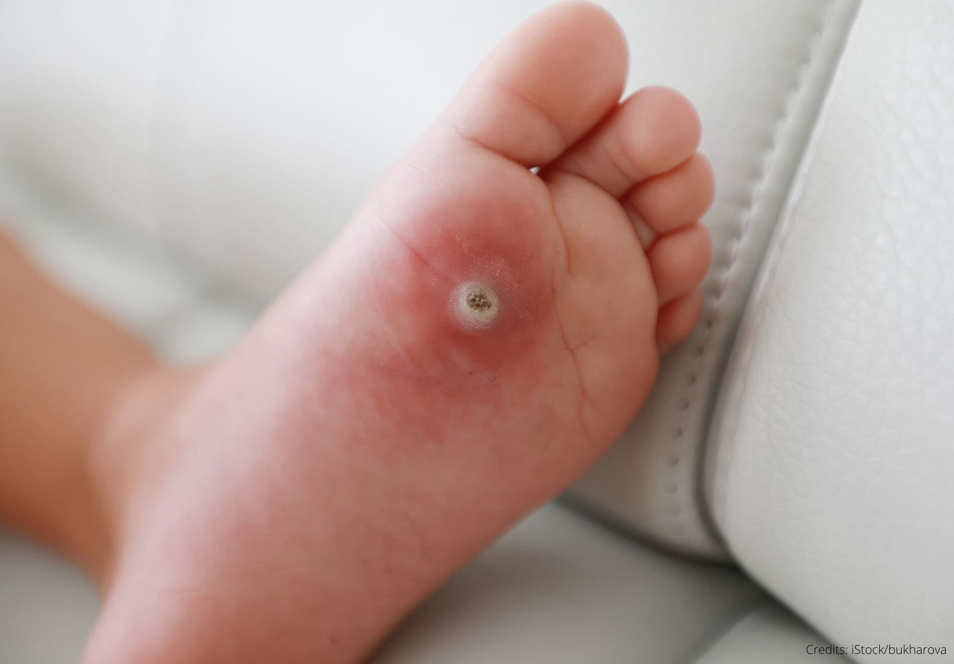 Schmerzen beim Gehen