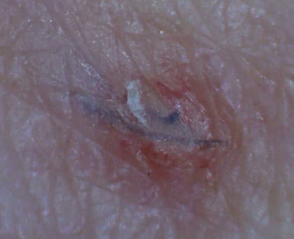 Sichtbares Haar unter der Haut