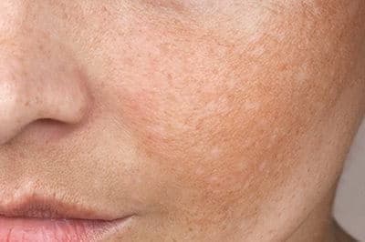 Sonnenexponierte Stellen