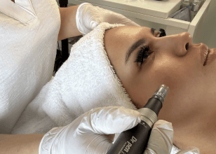 Microneedling Behandlung